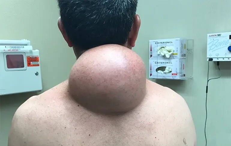Iemand met een bult zo groot als een voetbal bij Dr. Pimple Popper