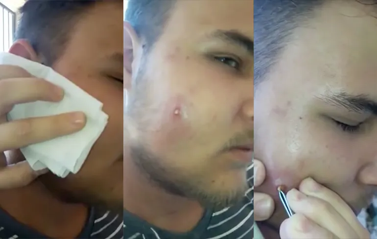 Ingegroeide haar laat een gapend gat achter