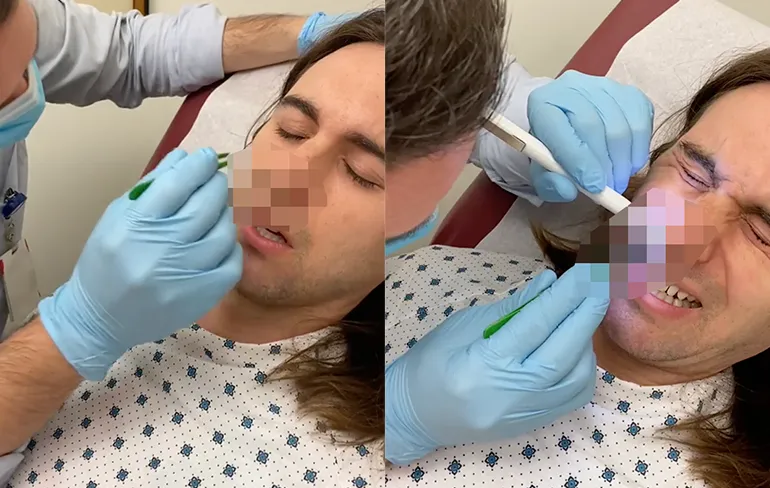 Internet kan uit: Dokter haalt grote worm uit neus van man