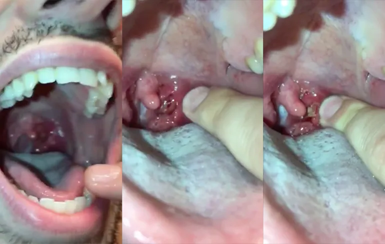 Internet kan uit: Speekselsteen ontploft in mond