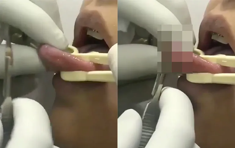 Internet kan uit: Zo wordt een gespleten tong gemaakt