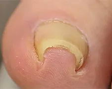 Japanse beugel voor teennagels...