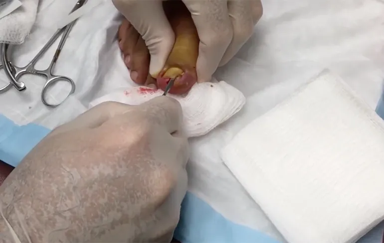 Kijken naar verwijderen ingegroeide teennagel op muziek van Beethoven