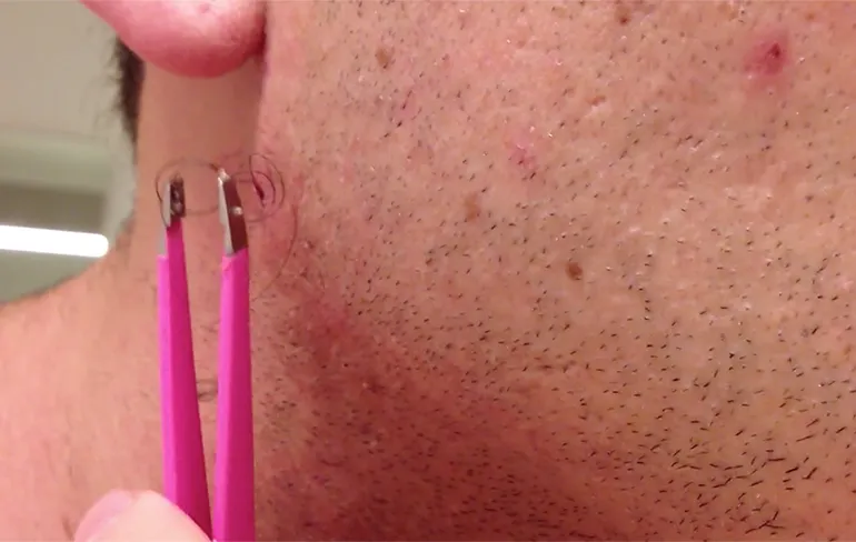 Last van wat ingegroeide haartjes