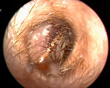 Logisch dat je een enorme kriebel in je oor hebt...