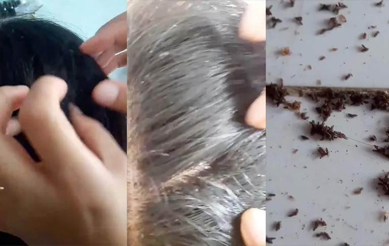 Luizen, luizen en nog eens luizen in kapperswinkel in Vietnam