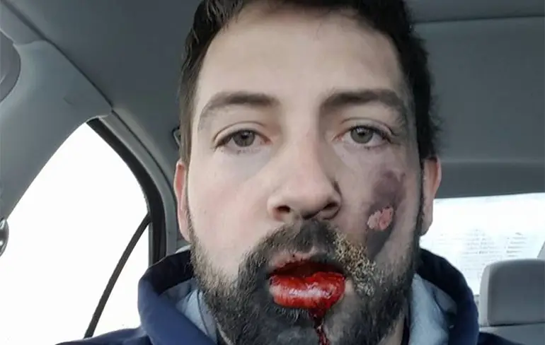 Man verliest 7 tanden door ontploffing e-sigaret