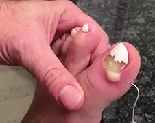 Man vindt pus uit teen knijpen nogal opgewonden klusje