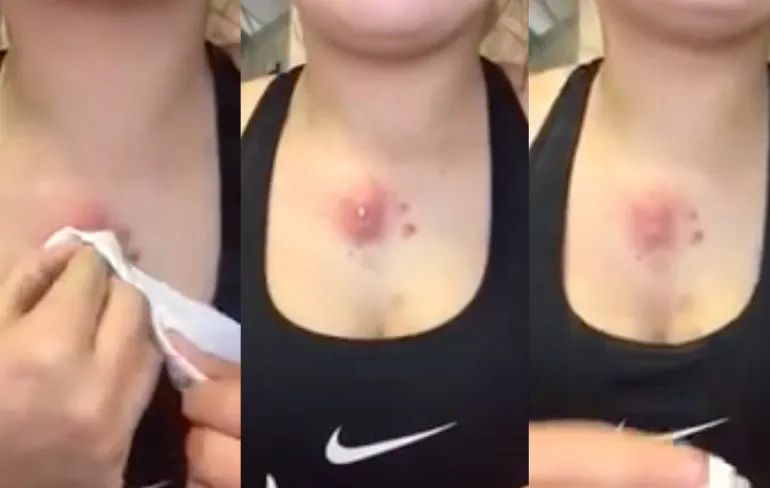 Meisje knijpt echt ranzige grote puist uit!