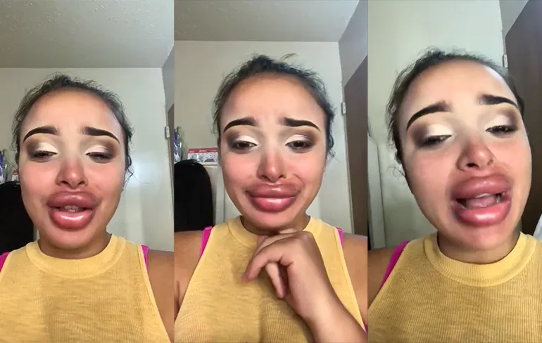 Meisje wil iets vollere lippen, meisje krijgt hele dikke lippen