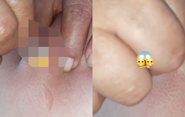 Mensen gaan slecht op video van vrouw die zonder handschoenen larven verwijdert