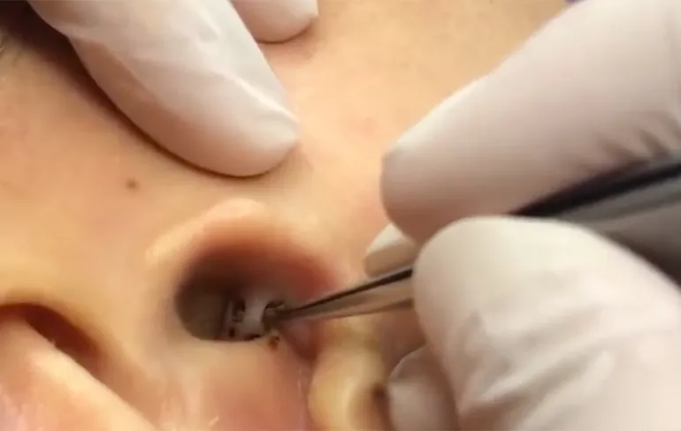 Niets is rustgevender dan kijken hoe mee-eters uit oor worden verwijderd