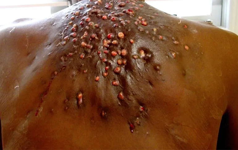 NOPE NOPE NOPE: Als je last hebt van horzel larven