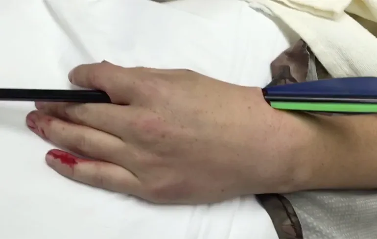 Pijl door je hand geschoten, en nu?