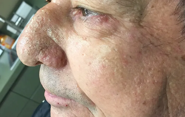 Plopperdeplop! Dr. Pimple Popper haalt zwarte puntjes bij Mr Wilson weg!