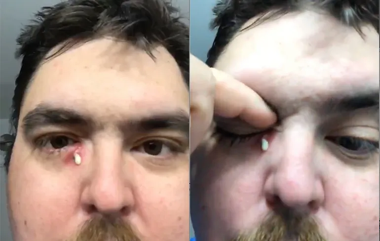 Puistje onder oog is er zeker eentje voor de liefhebbers