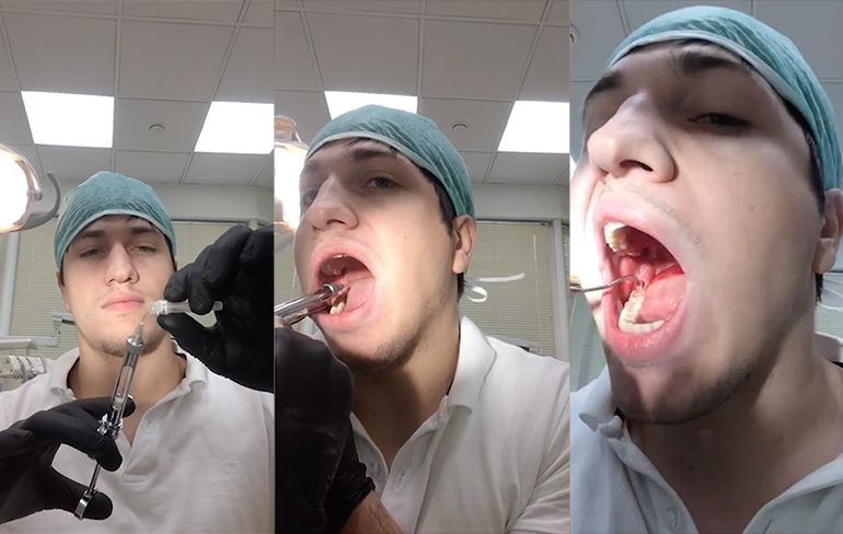 Russische tandarts trekt zijn eigen verstandskies