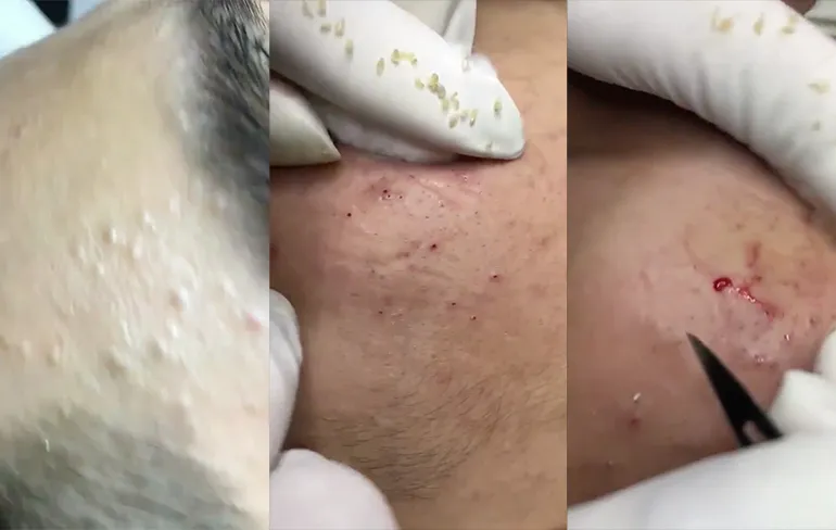 Rustgevend: 18 minuten aan mee-eters die geëlimineerd worden