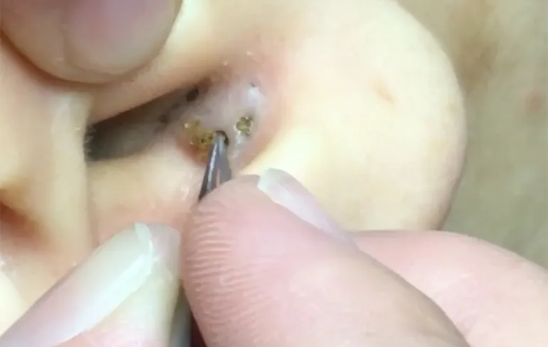 Rustgevend: Kijken hoe mee-eters uit oor worden verwijderd...