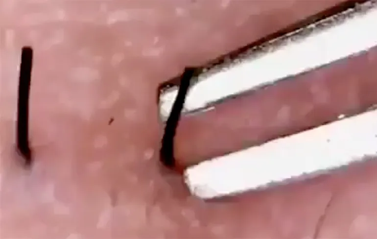 Rustgevend: Kijken naar verwijderen ingegroeide haren