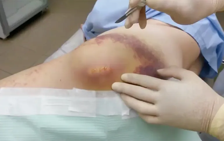 Sow, dat is best een grote cyste!