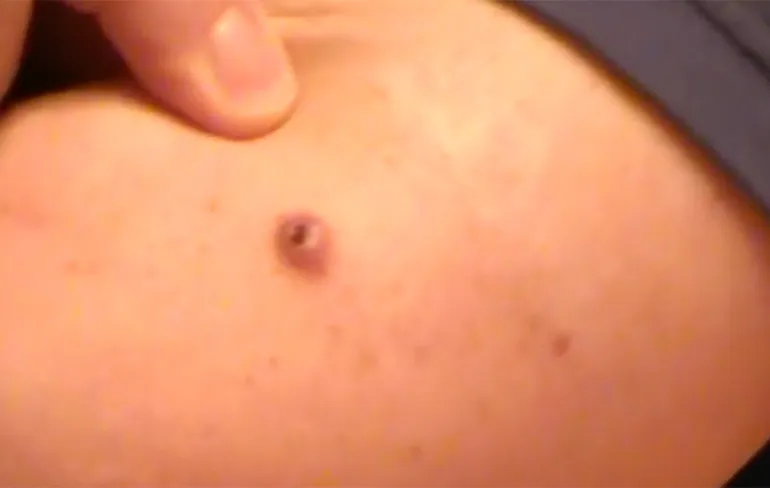 Stukje glas na 14 jaar uit elleboog verwijderen