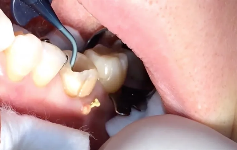 Tandarts aan het werk: Pus verwijderen uit tandvlees...