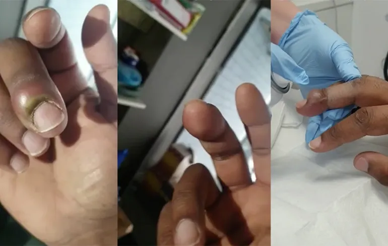 Toch maar even naar de dokter gegaan met infectie aan vinger