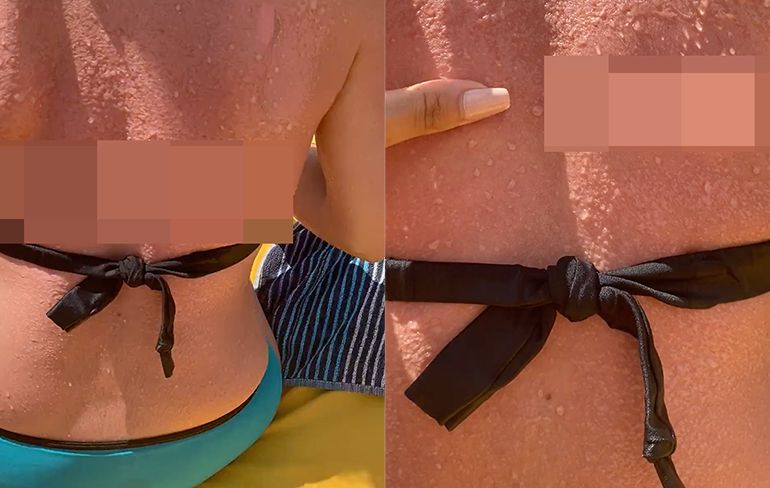 Toerist in Turkse Antalya had beter wel zonnebrand kunnen smeren