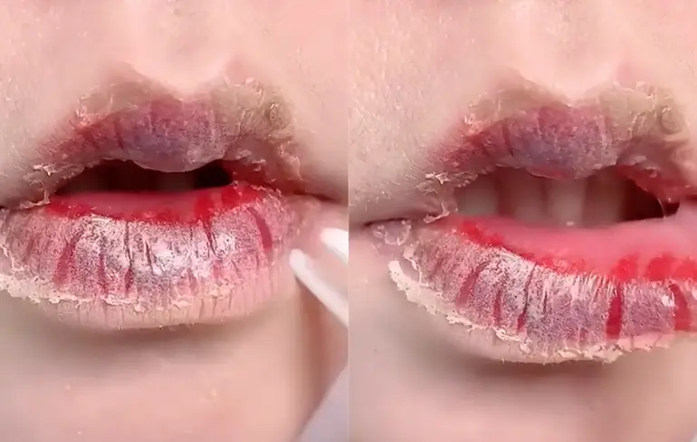 Velletje van droge lippen trekken is onaangenaam om naar te kijken