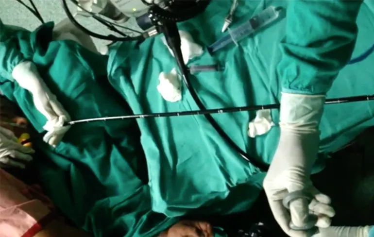 Video doktoren verwijderen lintworm van 188 centimeter via mond