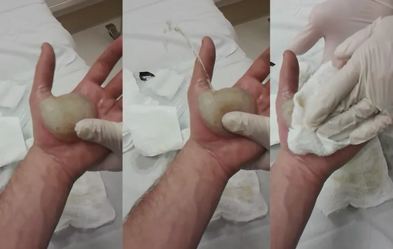 Video grote brandblaar wordt schoongemaakt...