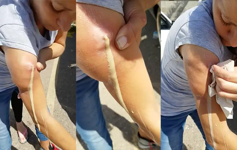 Vrouw drukt even een fontein van pus uit haar arm op parkeerplaats...