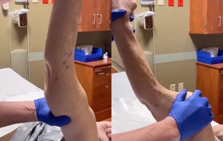 Vrouw had 12 jaar geleden een gebroken arm, maar de breuk is geheeld...