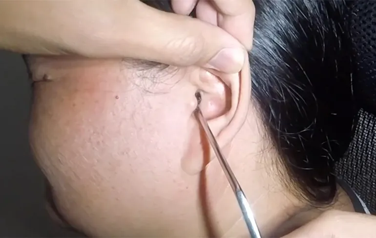 Vrouw heeft kakkerlak in haar oor en die moet er uit