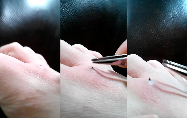 Vrouw vindt verrassing in haar voet