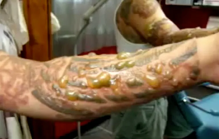 Wat blaren na weglaseren oude tattoo...