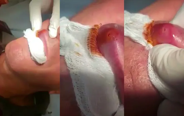 Wat je dus ook niet wilt hebben: Larve van horzel in je lip