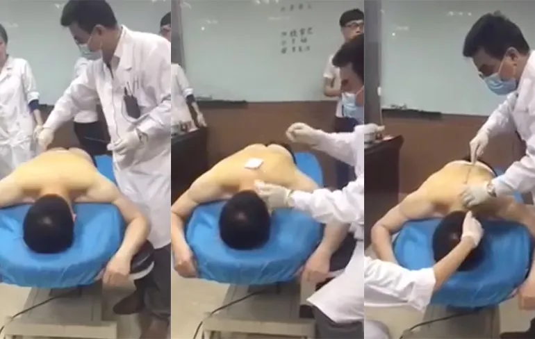 Zie jij een Dry needling behandeling wel zitten?