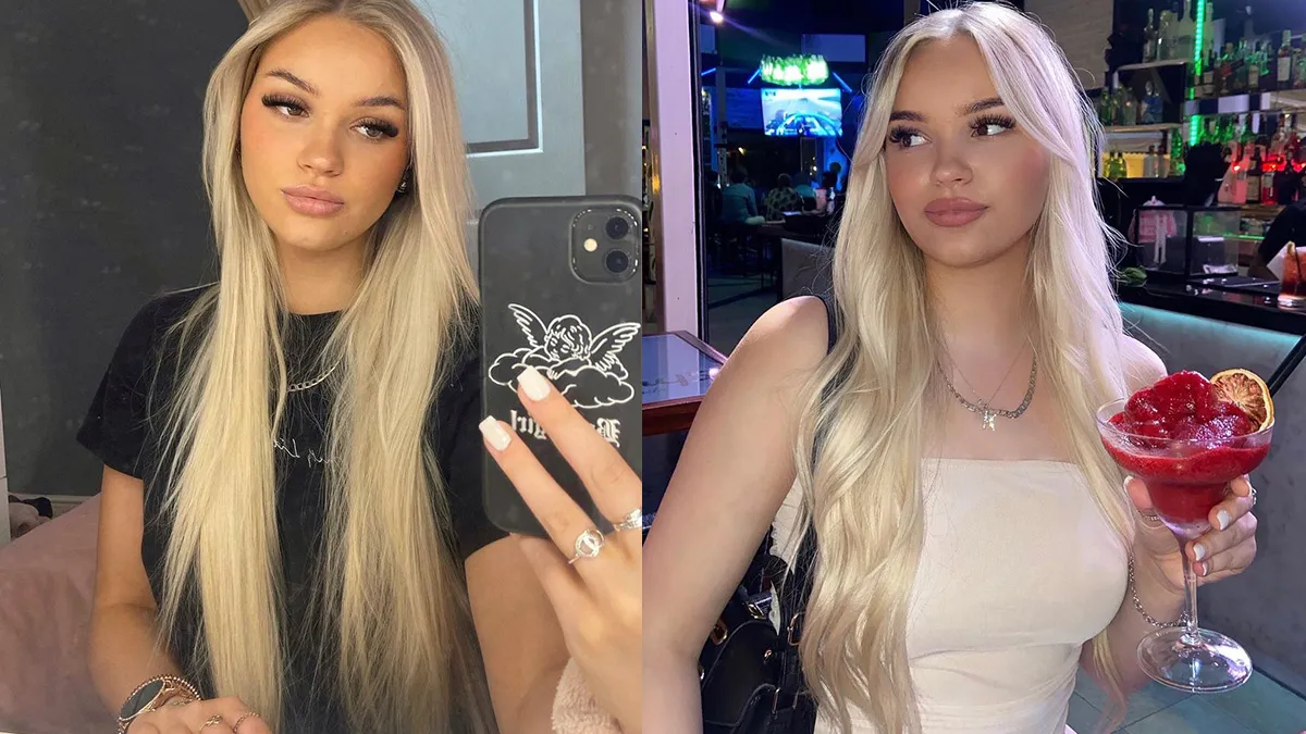 Dame laat zien wat fillers met haar gezicht hebben gedaan