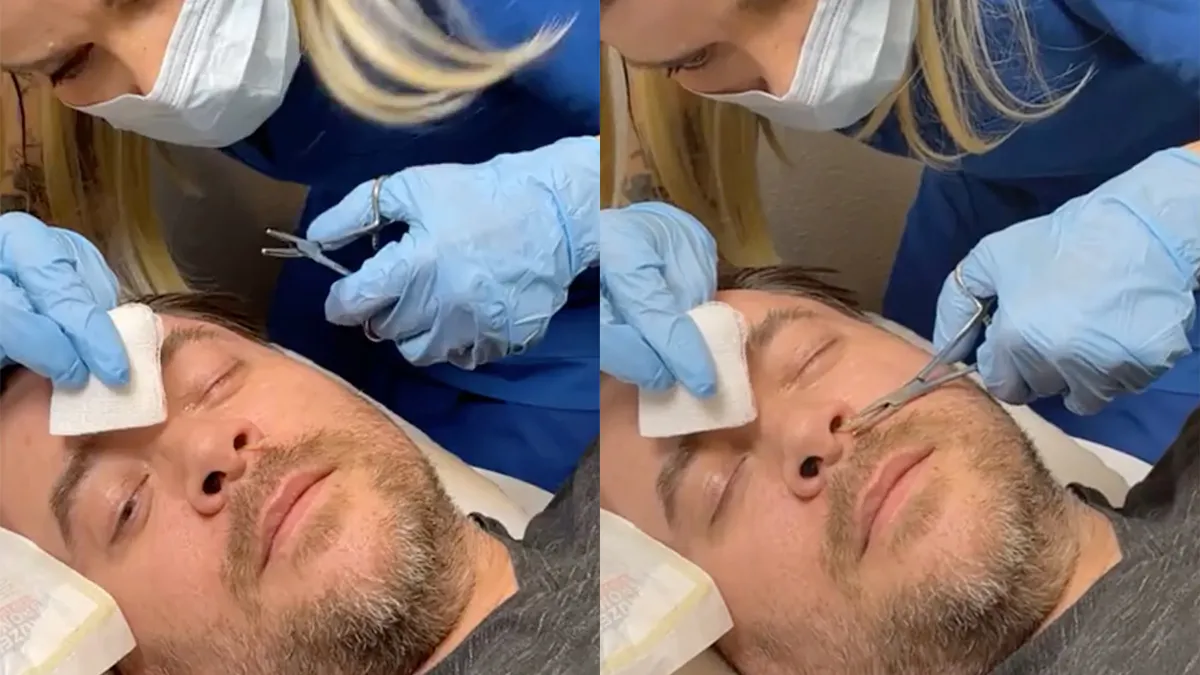 Materiaal om nachtmerries van te krijgen: Parasiet in je neus