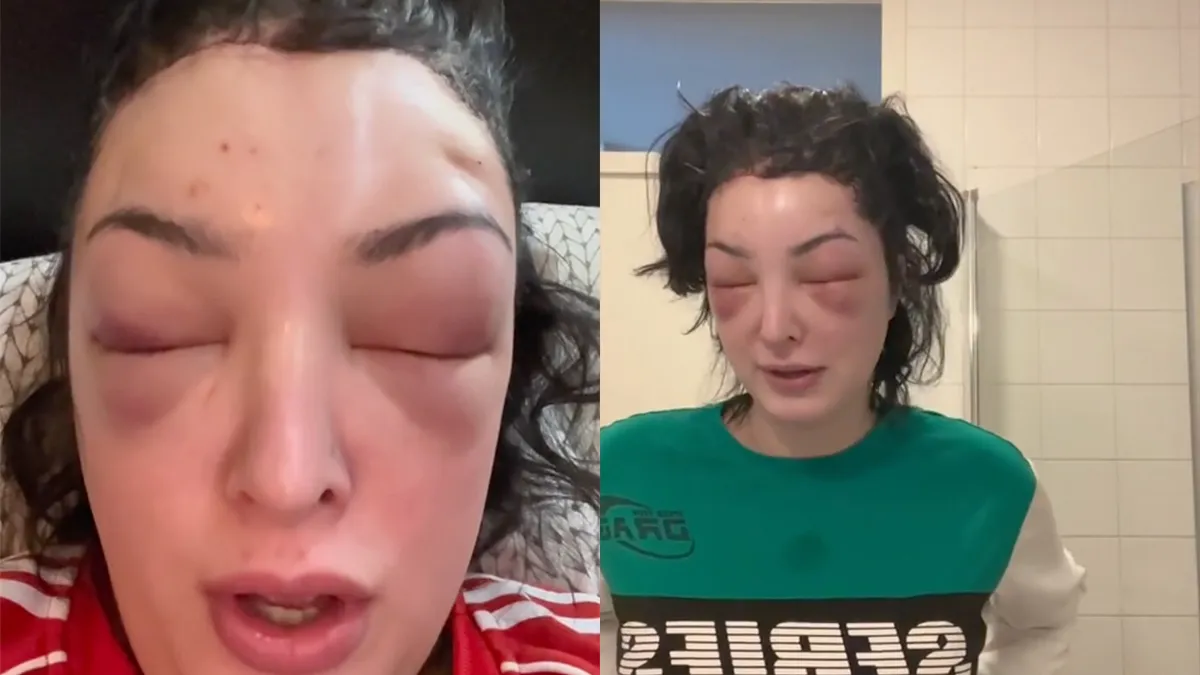 Aftermath van een Facial feminization surgery is best heftig