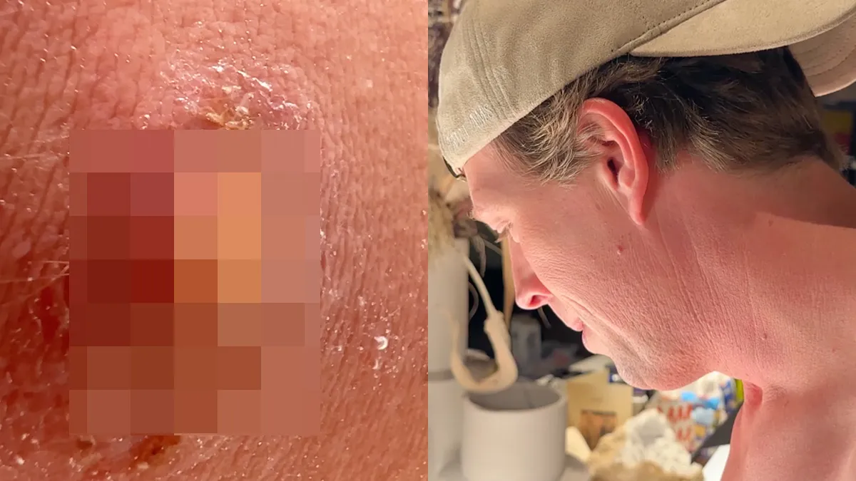 Trotse 'vader' Freek Vonk deelt eerste beelden van parasiet die uit zijn been is gekropen