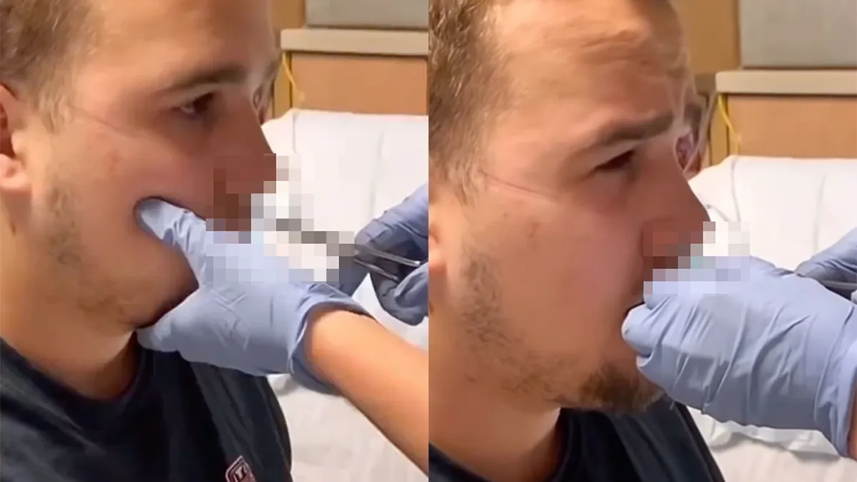 thumb vk het leven van een kno arts dit komt er uit een neus van een patient