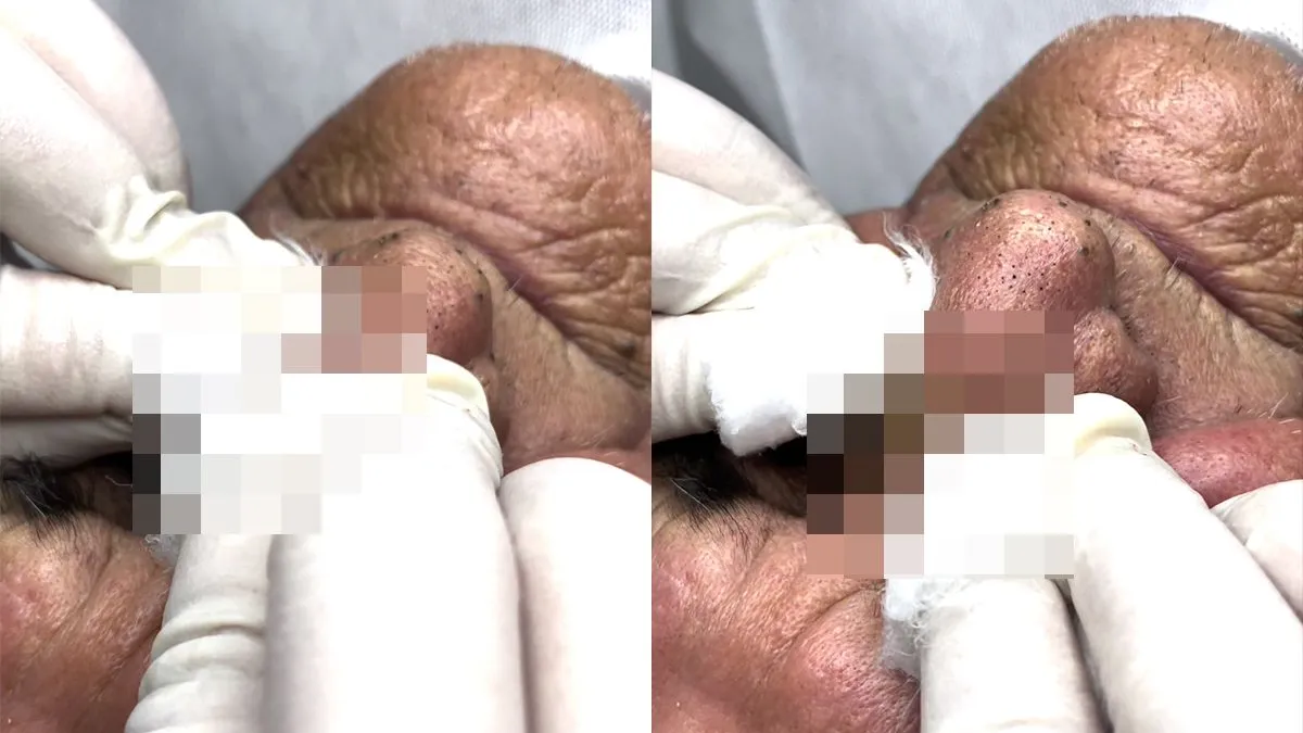 thumb vk niet zo fris filmpje neus met zwarte puntjes