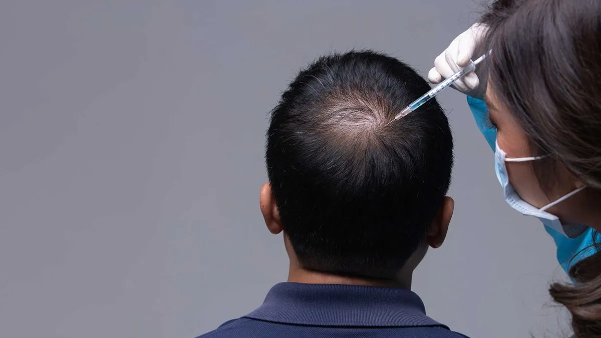 thumb vk wat kun je verwachten na een haartransplantatie