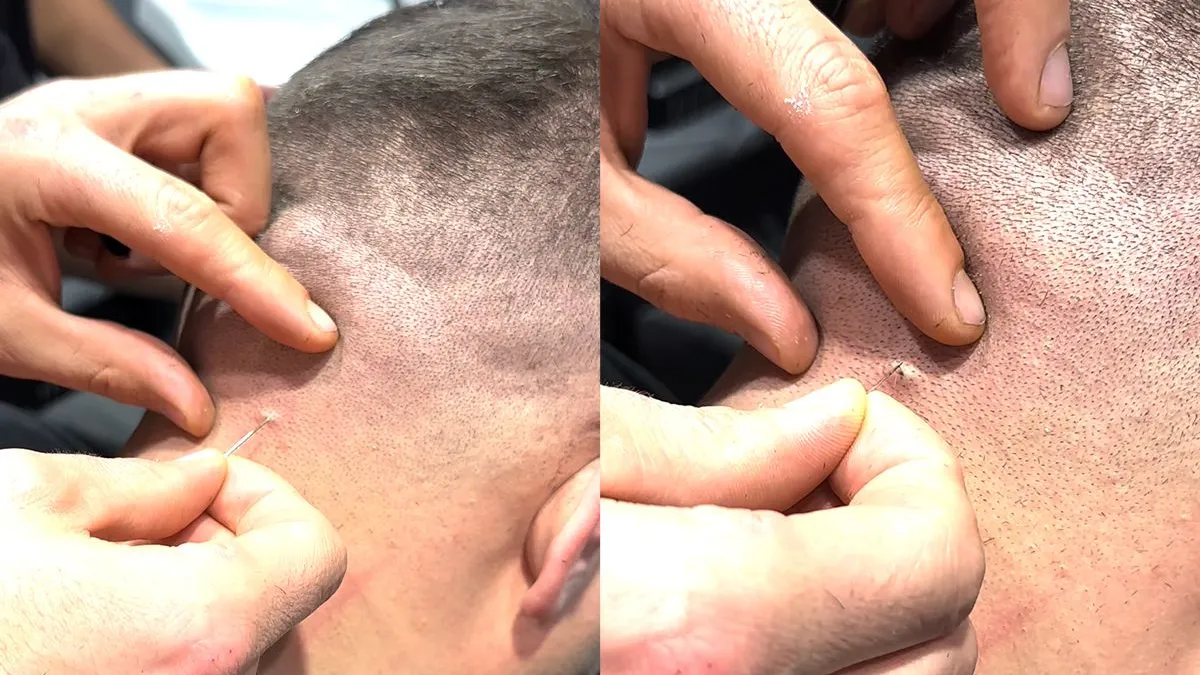 thumb vk kapper haalt ook maar gelijk even een ingegroeide haar weg