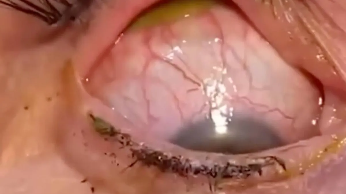 thumb vk niet voor een zwakke maag contactlensje kwijt