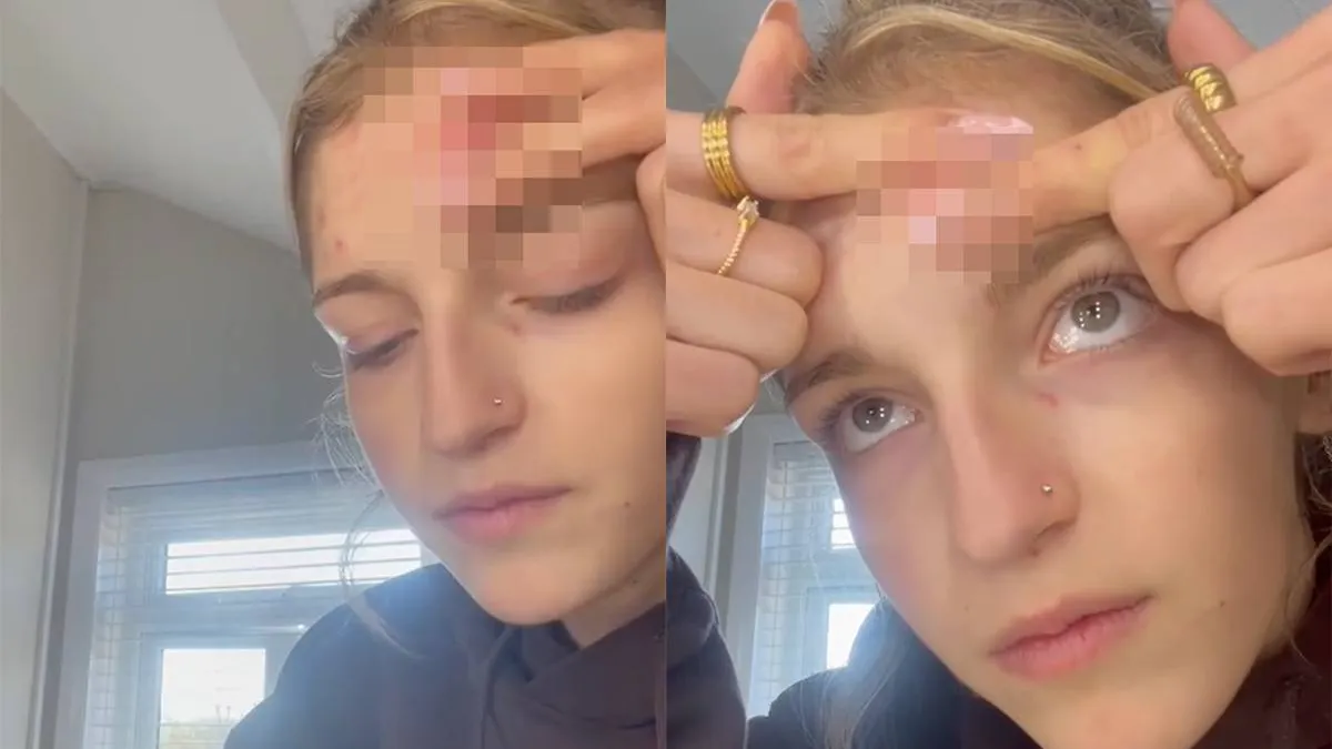thumb vk roxy steelt de show met puistjes uitknijpen