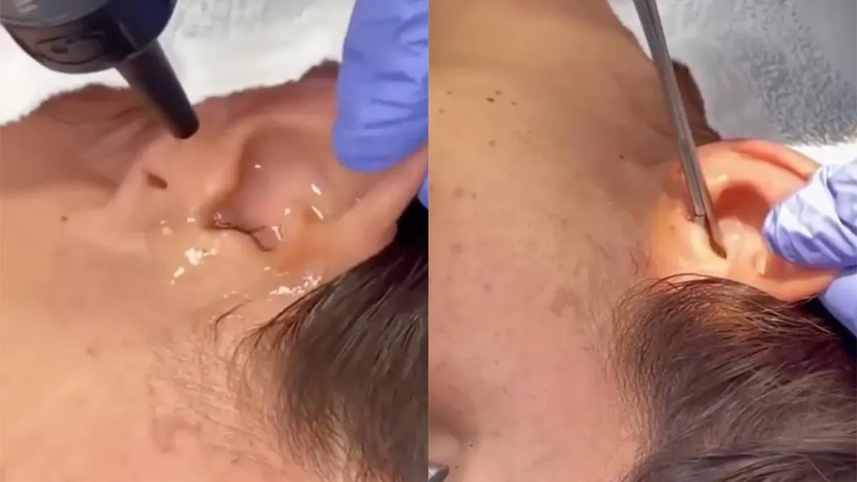 thumb_vk_Arts_haalt_levende_kakkerlak_uit_oor_van_vrouw